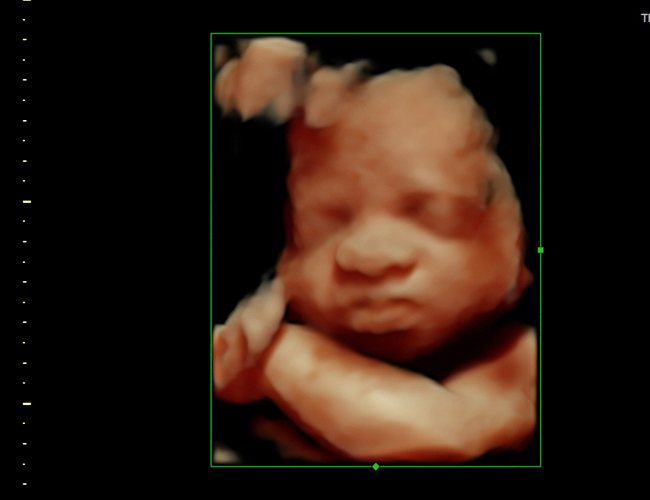 3D ultrasound image at 29 weeks